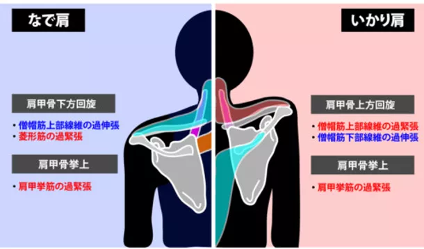 肩こり